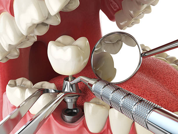 Best Chipped Tooth Repair Near Me  in Bethel, OH